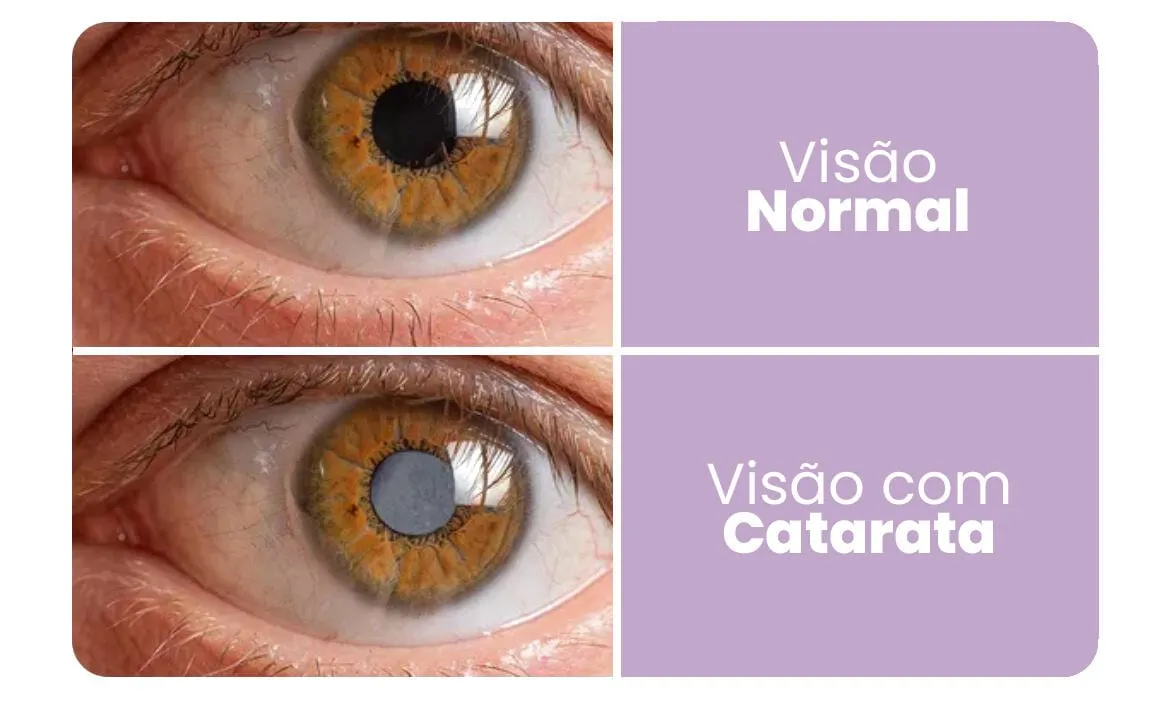 Comparação entre um olho com visão normal e um olho com catarata